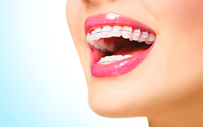 Woman smiling with clear braces