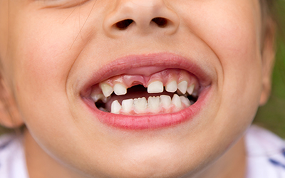 Young child missing teeth
