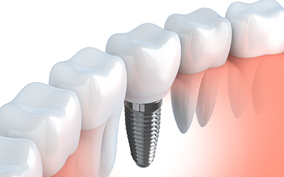 Dental Implant
