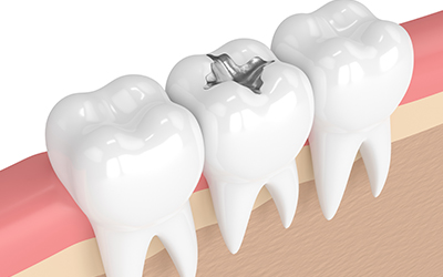 Filling in a tooth