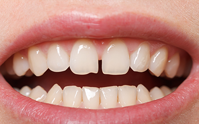 Causes Of Gaps Between The Teeth