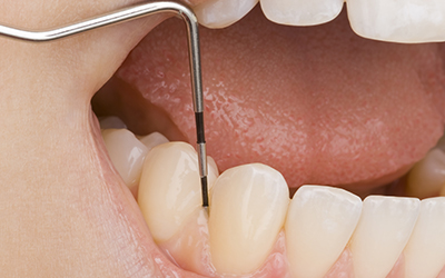 Up-close of dentist checking a persons gums