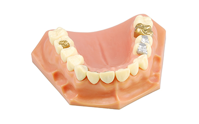 dental model of crowns