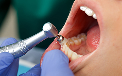 Professional dental brushing