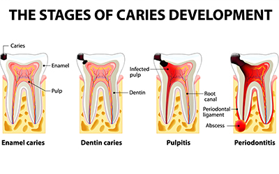 Stages of caries developement
