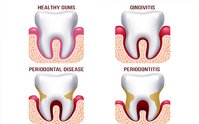 A diagram of the different stages of gum disease