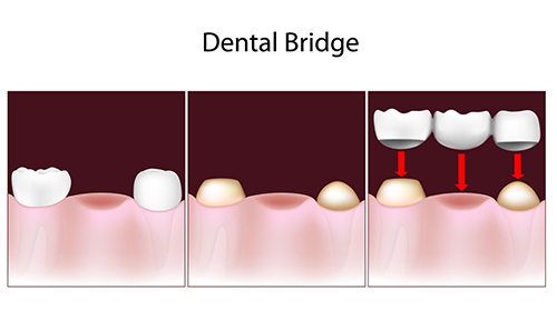 Diagram of dental bridge